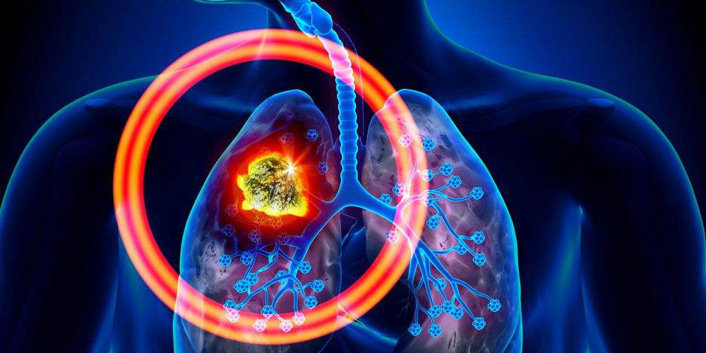 肺癌疫苗造福患者指日可待--新型EGF疫苗