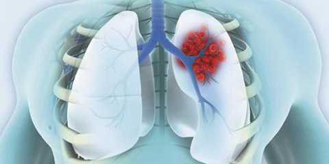 参加肺癌临床体验分享