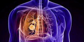 防止肺癌扩散，研究人员又有新发现！