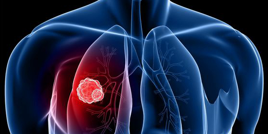 非小细胞肺癌的临床表现和分类有哪些