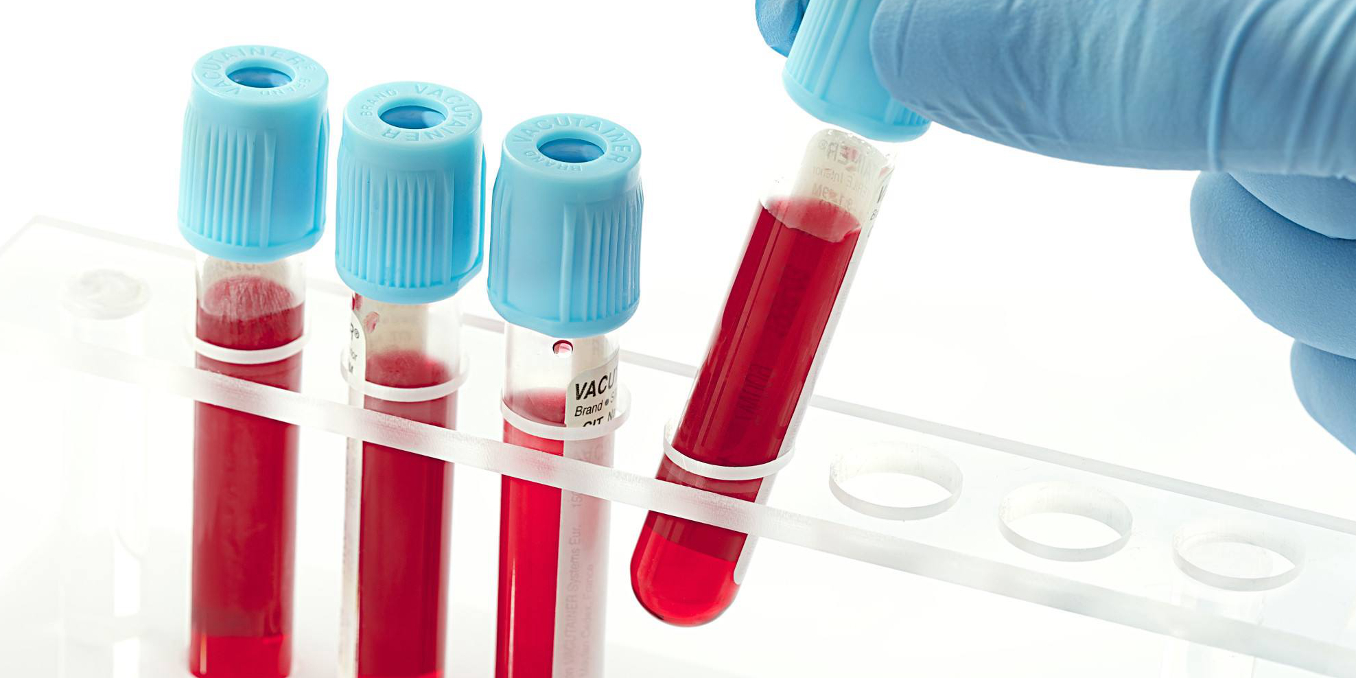 新血液检测方法：可帮助快速确立非小细胞肺癌的治疗方案！