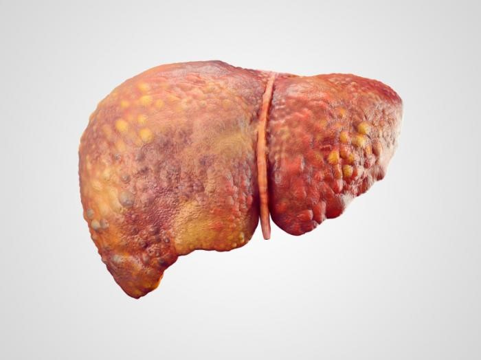 肥胖及2型糖尿病都与肝癌有关