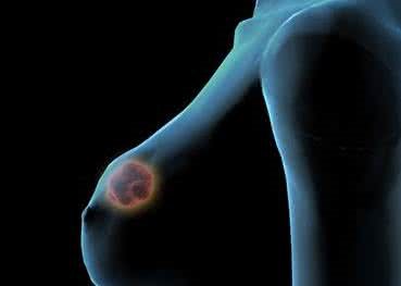 Faslodex获批用作HR +、HER2 - 乳腺癌晚期单药治疗