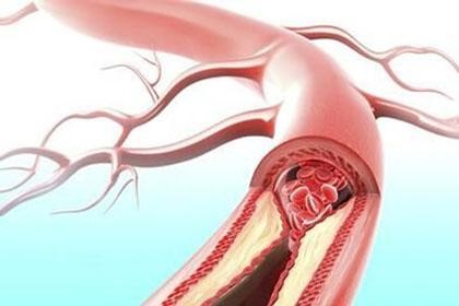 FDA批准Bevyxxa用于预防静脉血栓栓塞