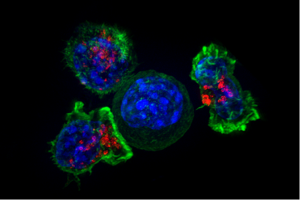 蛋白质水平可以预测肝癌复发的可能性