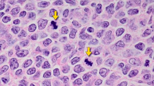 TP53突变的套细胞淋巴瘤患者预后极差