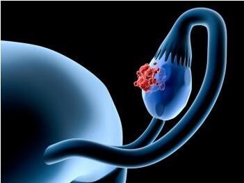 研究发现有12种遗传变异会增加了卵巢癌发病率