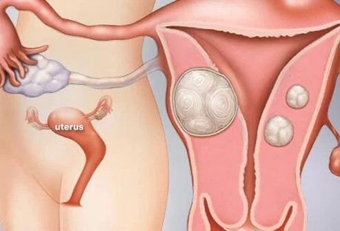 子宫肌瘤的诊断和症状