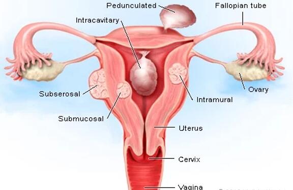 医疗图片辨识：子宫肌瘤的图片
