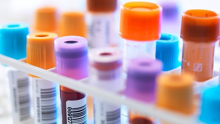 每年都进行血液检查可能有助于防止卵巢癌死亡
