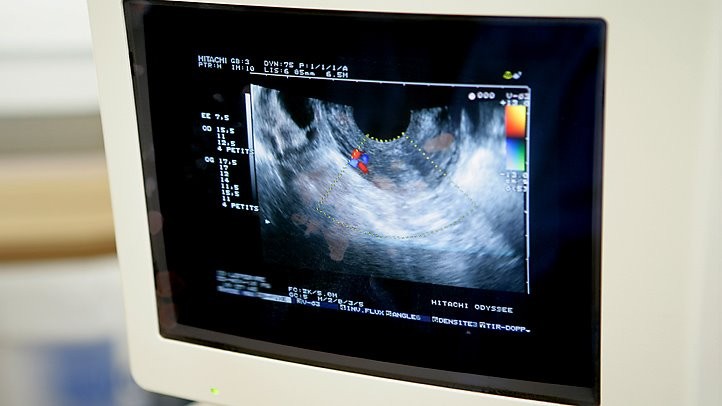 卵巢癌筛查研究并未显示出如预期的显著效益