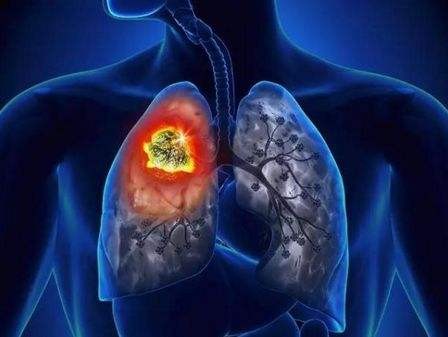 肺癌的征兆和症状