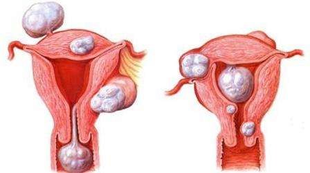 子宫肌瘤栓塞有助于恢复子宫肌瘤患者生育能力