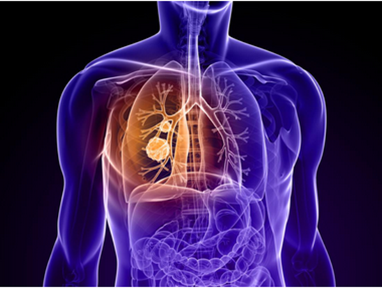 单分子决定肺癌细胞死亡