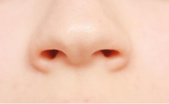 鼻拭子有助于肺癌诊断