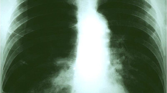 研究显示，血液染色体检测可预测肺癌复发