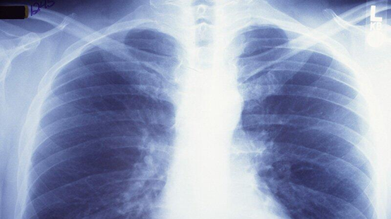 放疗联合化疗可大大提高肺癌患者的生存率