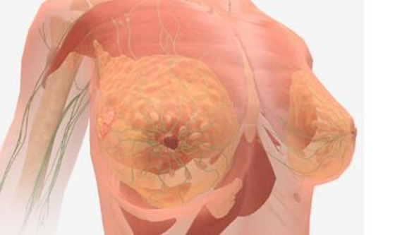 4期乳腺癌有哪些症状？
