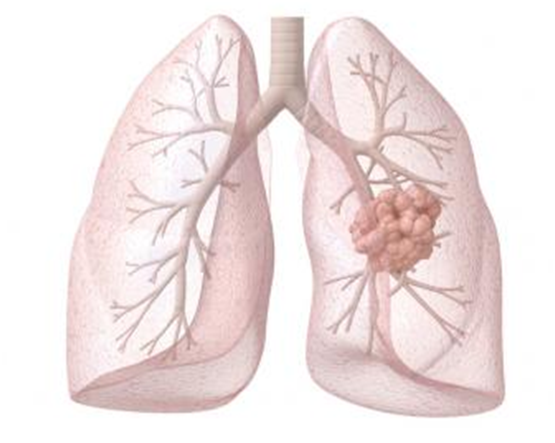 关于转移性肺癌