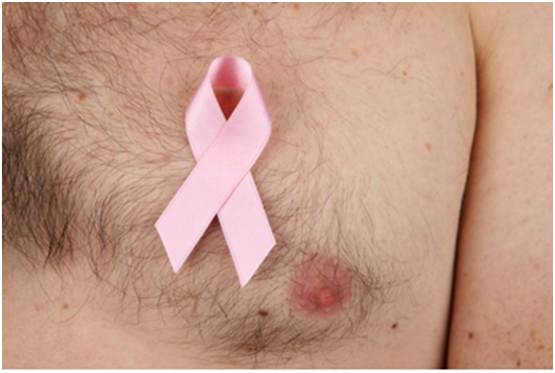 研究发现男性乳腺癌相关蛋白，或许离新疗法不远了