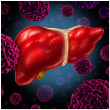 晚期肝癌:选择性放疗比索拉非尼更安全