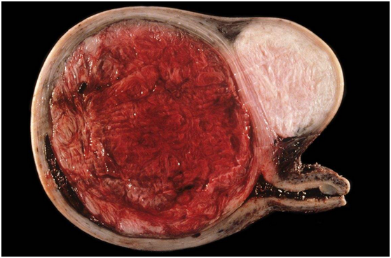 子宫之外的子宫肌瘤