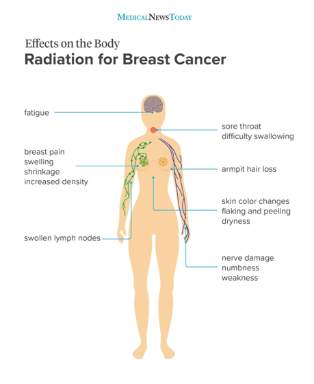乳腺癌放疗有什么副作用？