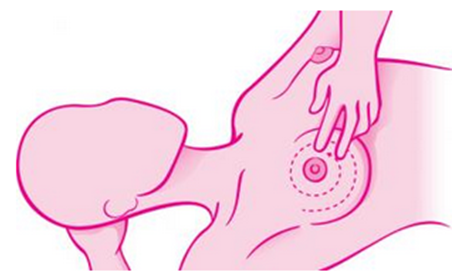 乳腺癌的自我检查法
