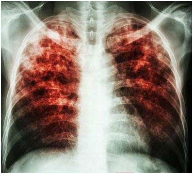 转移性非小细胞肺癌患者治疗呼吸急促秘诀之三