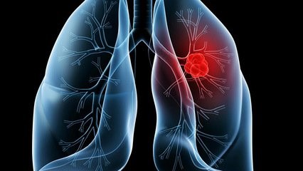多个基因突变导致了致命肺癌