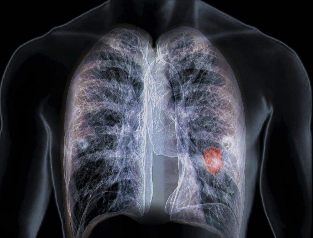 肺癌是如何确诊的？