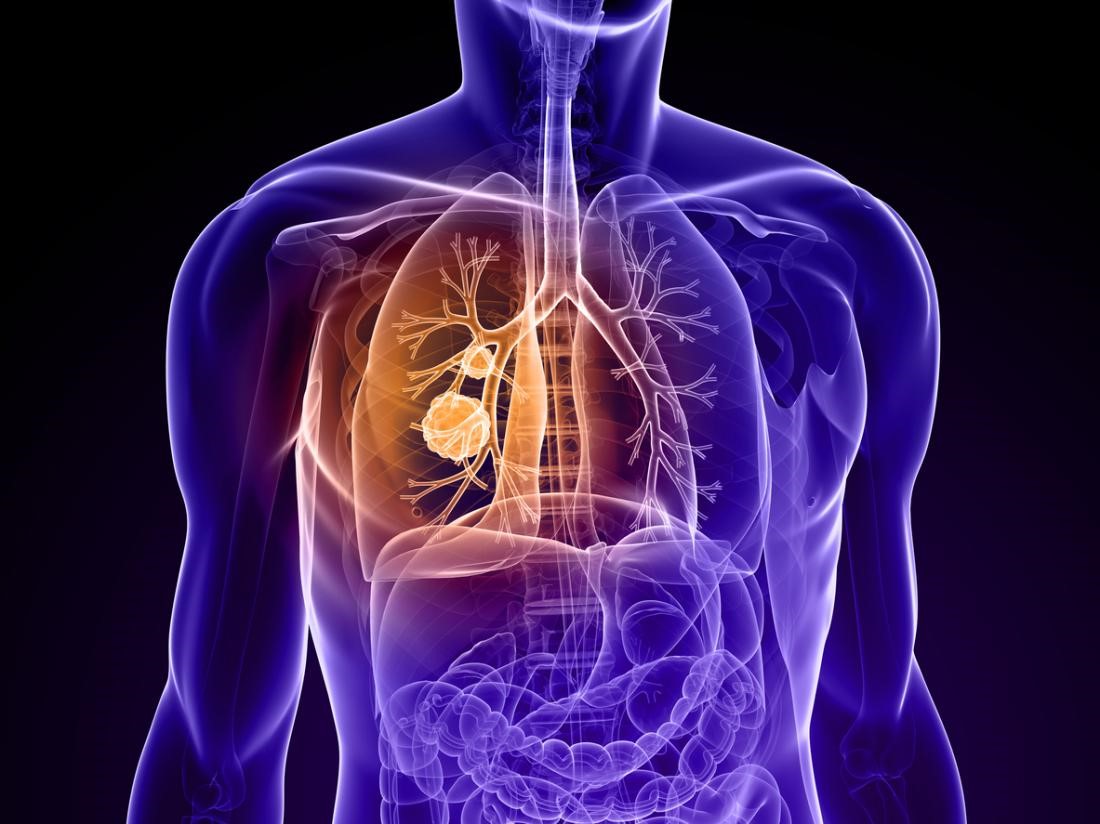 中国肺癌最新概况出炉：每分钟就有一个肺癌患者确诊-觅健