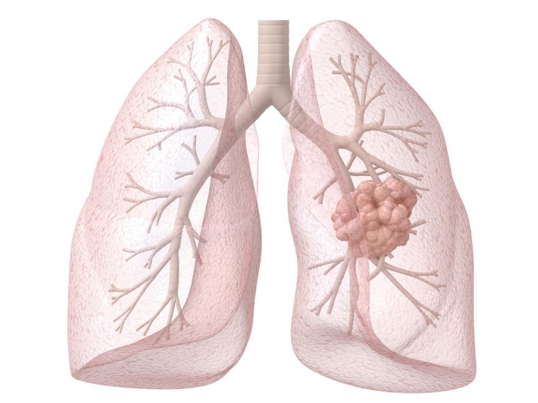 维生素B与肺癌风险增加有关